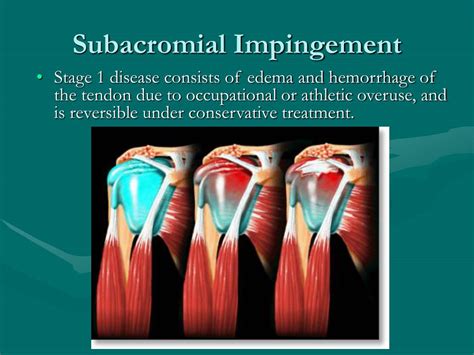 Subacromial Impingement Syndrome Physiocure Vrogue Co