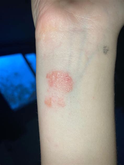 Weird Rash On Wrist Rmedicaladvice