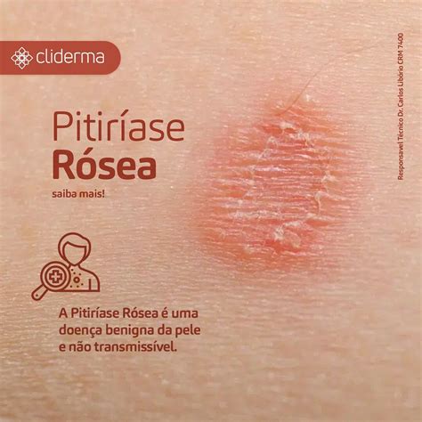 Pitiríase Rósea é Uma Doença Eruptiva Clínica Cliderma