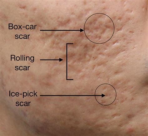 Acne Scars The Treatment Options