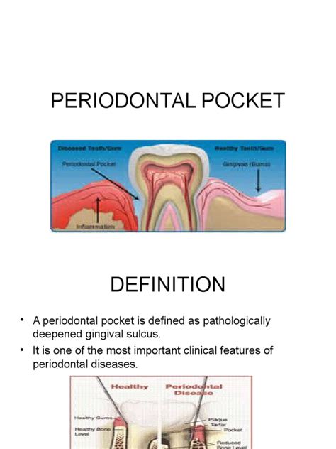 Periodontal Pocket Dentistry Mouth