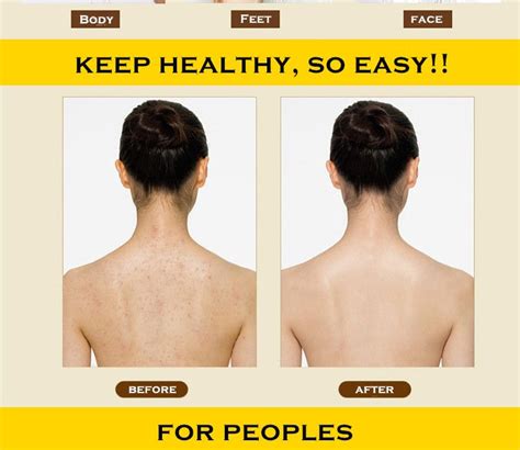 85g Shanghai Sulfur Soap 4 Skin Conditions Acne Psoriasis Seborrhea