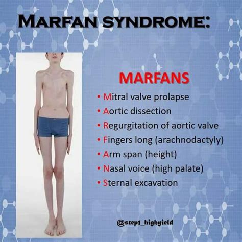 Marfan Syndrome Featurea Medizzy