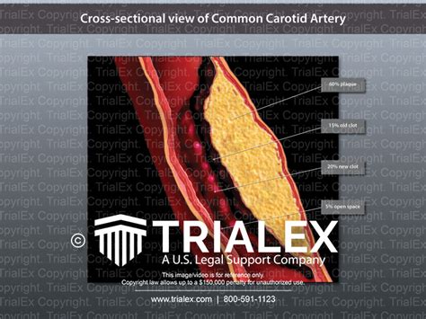 Cross Sectional View Of Common Carotid Artery Trialexhibits Inc
