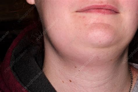 Charlotte Richardson Kabar Swollen Lymph Nodes In Neck One Side Thyroid