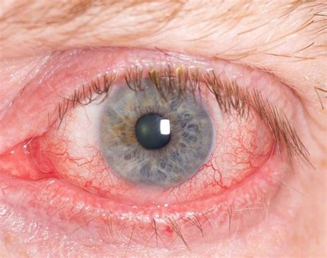 Dr Karen On Conjunctivitis Sunday World Dry Eye Symptoms Dry Eyes