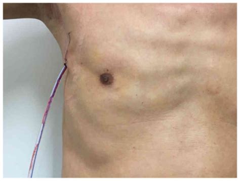 Single‑incision Surgery For Gynecomastia Using Triport A Case Report