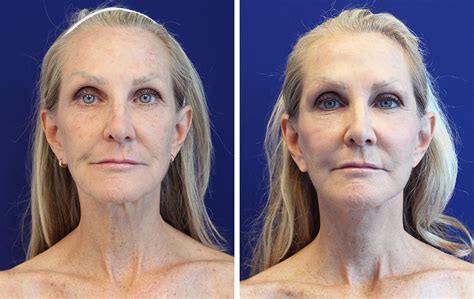 Can You Have A Neck Lift Without A Face Lift Jason Cooper Md