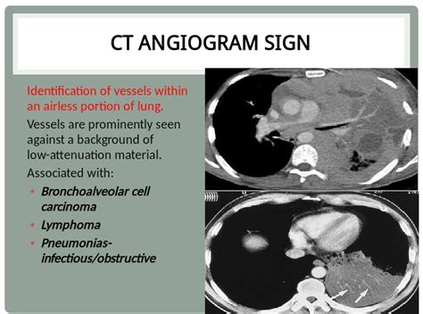Chest Medicine Made Easy Dr Deepu Ct Angiogram Sign