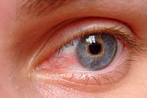 Pterygium Surfer S Eye Causes Symptoms And Treatments