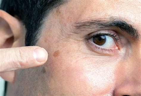 What Does Skin Cancer Look Like On Your Face