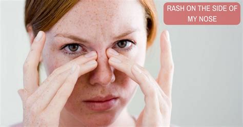 What Are The Causes Of A Rash On The Nose Bridge