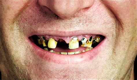 Avoid chewing with your front teeth, which could displace your dentures. Up in Smoke: How does cheewing feel now?