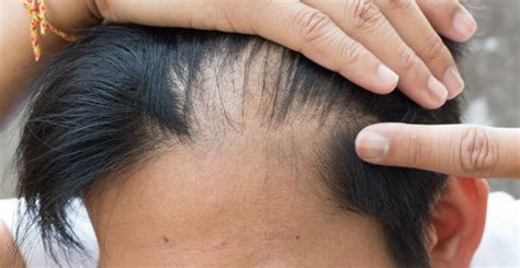 I Have An Itchy Scalp Do I Have Scalp Psoriasis Orlando Fl Dr Jeannette Hudgens