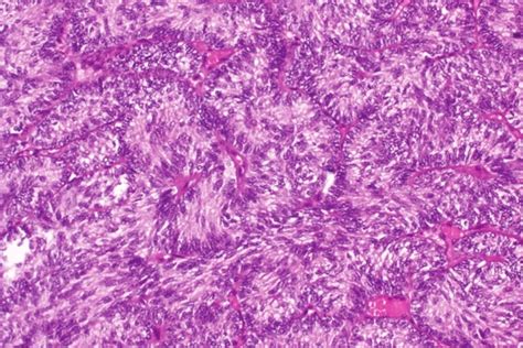 Photomicrograph Of Adult Granulosa Cell Tumor Histopathology Tumor