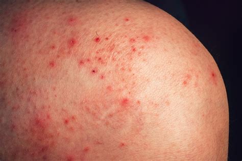 Keith Greer Buzz Red Spots On Skin Not Itchy
