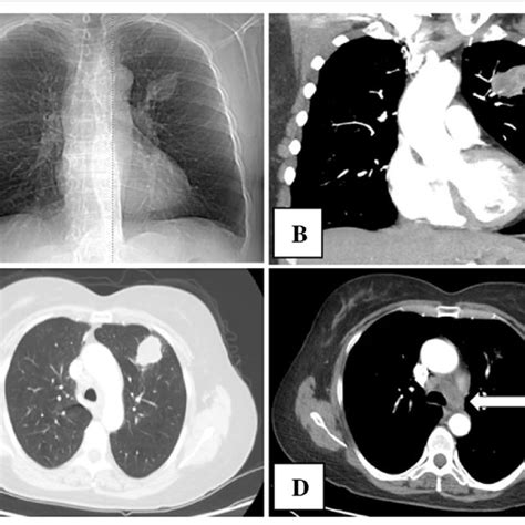 Chest X Ray And Computed Tomography Showed A Tumor In The Left Lung