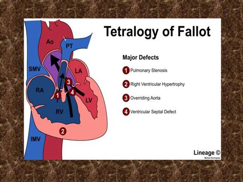 Tetralogy Of Fallot And Tet Spell Presentation