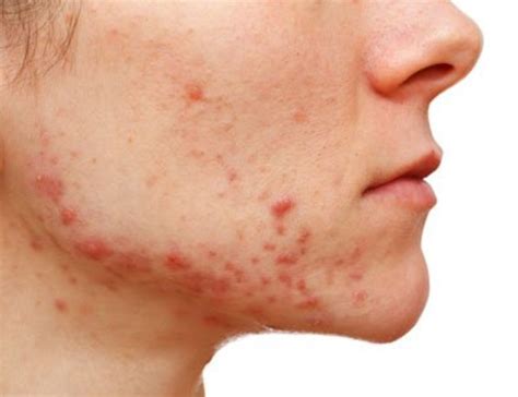 How To Get Rid Of Adult Acne In 3 Steps Innate Skin