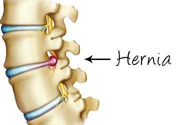 A hernia usually develops between your chest and hips. Hernia bij ruiters - Oefentherapie Bolsward