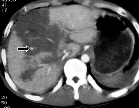 Ct In Blunt Liver Trauma Radiographics