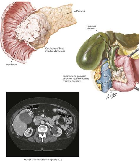 Pancreaticoduodenectomy Basicmedical Key