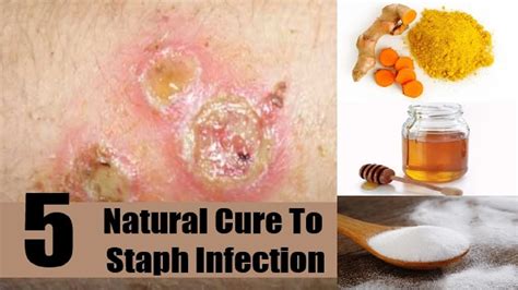 5 Home Remedies For Staph Infection On Face By Top 5 Youtube