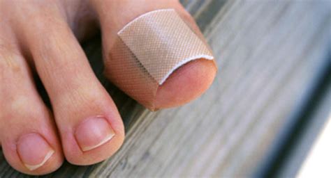 Hammer Toe 10 Causes Of Hammer Toe