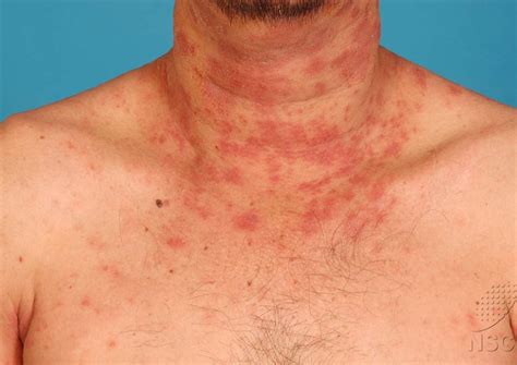 Sweat Skin Health Key For Atopic Dermatitis Sufferers Health News