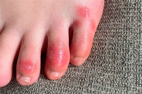 Immune System Overreaction May Cause Covid Toes Study Says The New