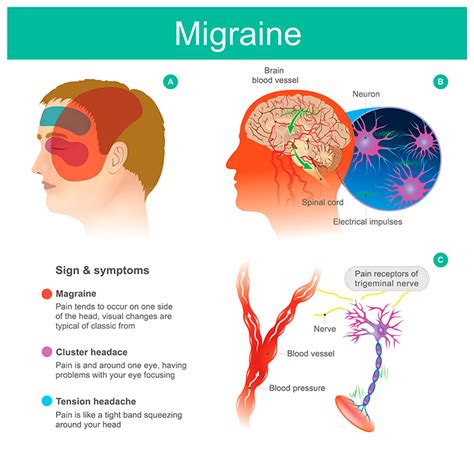 Health And Meditation Migraine Symptoms