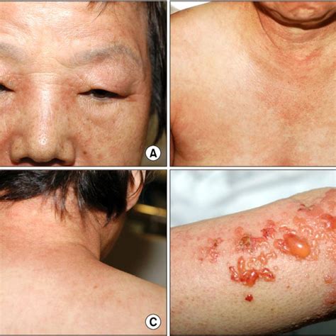 Skin Lesions A Periorbital Erythema And Edema Heliotrope Rash B