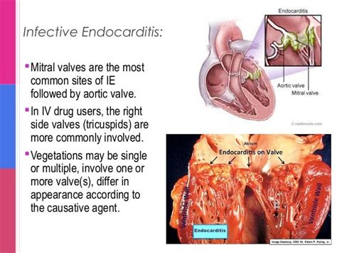 Cvs Pathology 1 Rheumatic Heart Disease Infective Endocarditis And