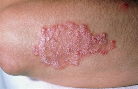 Psoriasis Vs Lupus Similarities And Differences