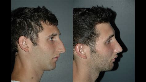 Male Rhinoplasty Before And After Nyc Youtube