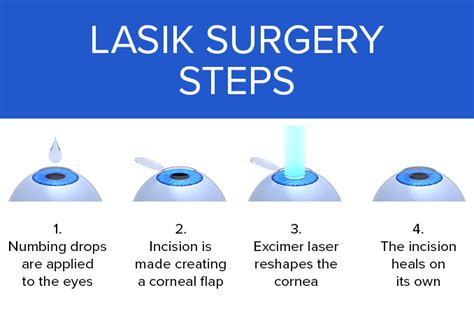 Guide To Lasik Eye And Vision Surgery All About Vision