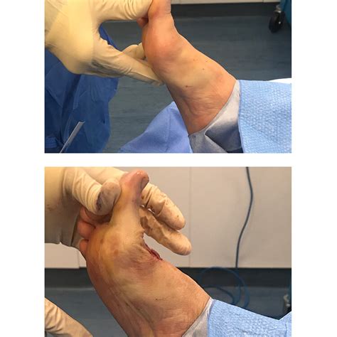 Hallux Rigidus And Cartiva Surgery Foot And Podiatry Surgery