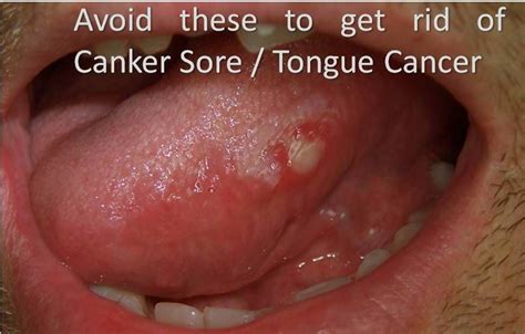 Canker Sore On Tongue Treatment Learnwebdesigner