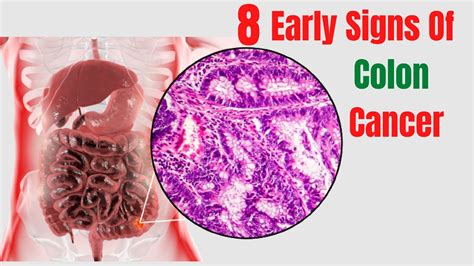 Top Early Warning Signs Of Colon Cancer Colon Cancer First Stage