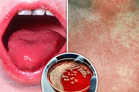 what are the signs of scarlet fever hot sex picture