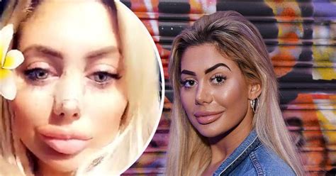 Chloe Ferry Unveils The Incredible Results Of Her Recent Boob And Nose