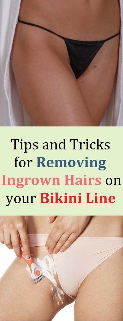 Tips And Tricks For Removing Ingrown Hairs On Your Bikini Line Ingrown Hair Ingrown Hair