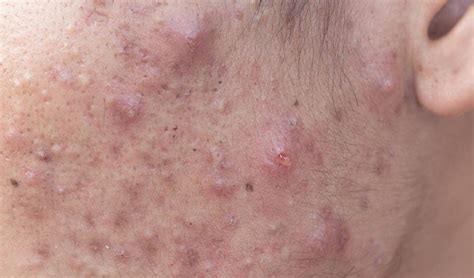11 Home Remedies For Cystic Acne If Youve Ever Suffered From Cystic