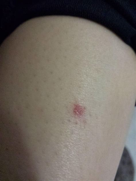 Girlfriend Got This Red Spot On Her Shin It Grew From A Tiny Dot To