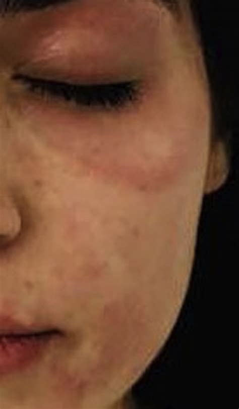 Images Of Hives On Lips