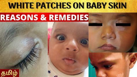 How To Cure Baby Skin White Patches In Tamilbaby Skin White Patches