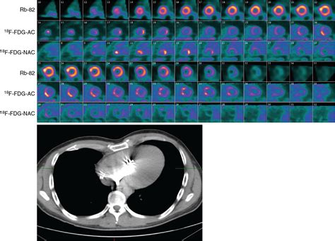 Recognizing And Preventing Artifacts With Spect And Pet Imaging Radiology Key