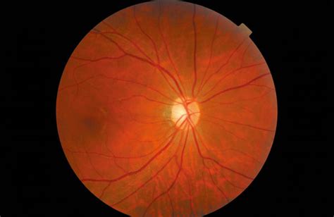 Gordon Turner Optometrists Opticians Cheam Retinal Photography