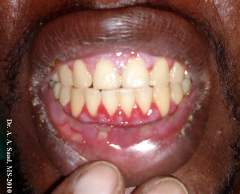Pemphigus Vulgaris Oral Lesions Dermrounds Dermatology Network