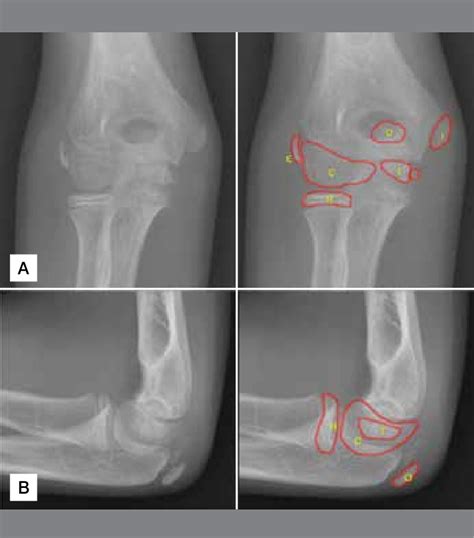 Ossification Centers Elbow